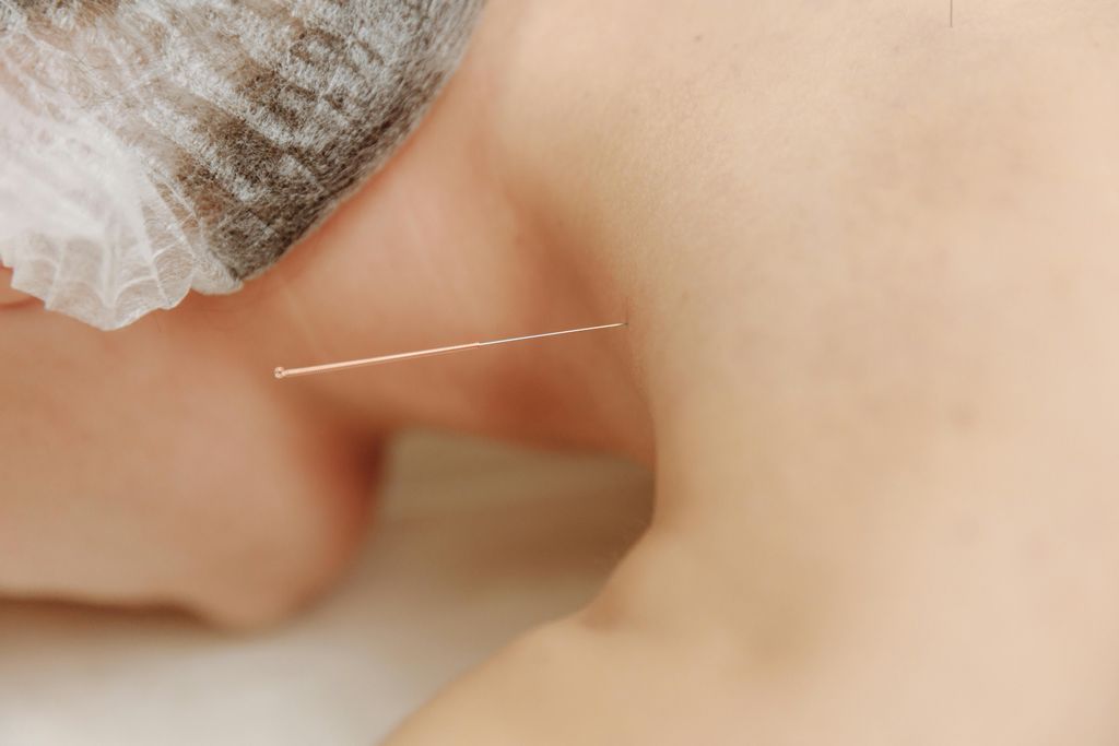 Acuponcture